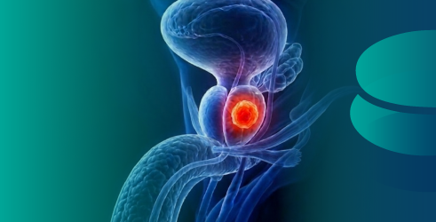 Ciencia, innovación y la nueva era de la detección temprana del cáncer de próstata